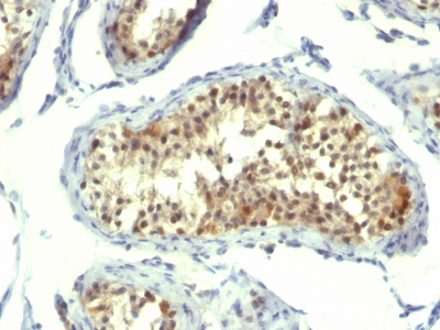 Formalin-fixed, paraffin-embedded human Testicular Carcinoma stained with Thymidylate Synthase Monoclonal Antibody (TMS715).