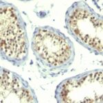 Formalin-fixed, paraffin-embedded human Testicular Carcinoma stained with Thymidylate Synthase Monoclonal Antibody (TS16 + TMS715).