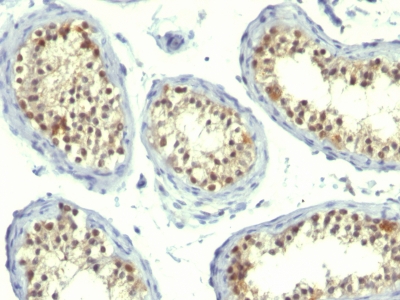 Formalin-fixed, paraffin-embedded human Testicular Carcinoma stained with Thymidylate Synthase Monoclonal Antibody (TS16 + TMS715).