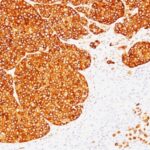 Formalin-fixed, paraffin-embedded human Melanoma stained with Tyrosinase Monoclonal Antibody (SPM36).