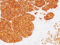 Formalin-fixed, paraffin-embedded human Melanoma stained with Tyrosinase Monoclonal Antibody (SPM36).