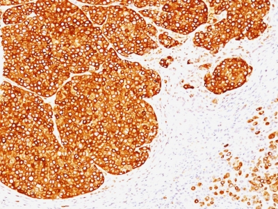 Formalin-fixed, paraffin-embedded human Melanoma stained with Tyrosinase Monoclonal Antibody (SPM36).