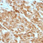 Formalin-fixed, paraffin-embedded melanoma stained with Tyrosinase Monoclonal Antibody (OCA1/812).