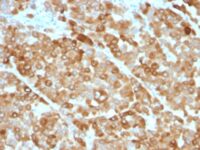 Formalin-fixed, paraffin-embedded melanoma stained with Tyrosinase Monoclonal Antibody (OCA1/812).