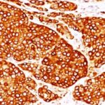 Formalin-fixed, paraffin-embedded Melanoma stained with Tyrosinase Monoclonal Antibody (T311 + OCA1/812).