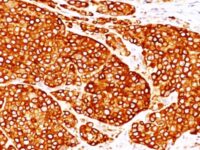 Formalin-fixed, paraffin-embedded Melanoma stained with Tyrosinase Monoclonal Antibody (T311 + OCA1/812).