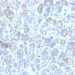 Formalin-fixed, paraffin-embedded human Melanoma stained with TYRP1 Monoclonal Antibody (TYRP1/87)