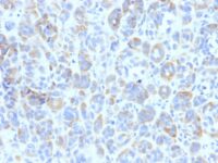 Formalin-fixed, paraffin-embedded human Melanoma stained with TYRP1 Monoclonal Antibody (TYRP1/87)