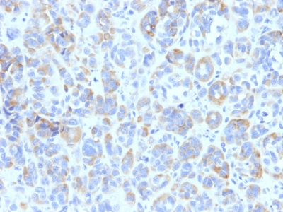 Formalin-fixed, paraffin-embedded human Melanoma stained with TYRP1 Monoclonal Antibody (TYRP1/87)
