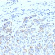 Formalin-fixed, paraffin-embedded human Melanoma stained with TYRP1 Monoclonal Antibody (SPM611)