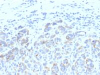 Formalin-fixed, paraffin-embedded human Melanoma stained with TYRP1 Monoclonal Antibody (SPM611)