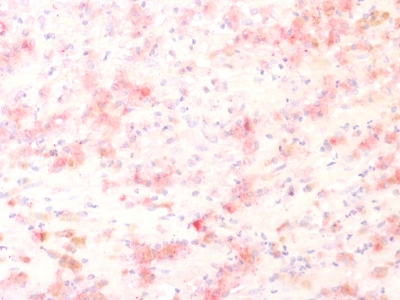 Formalin-fixed, paraffin-embedded human Melanoma stained with TYRP1 Recombinant Rabbit Monoclonal Antibody (TYRP1/1564R) using AEC Chromogen (red).