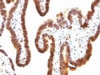 Formalin-fixed, paraffin-embedded human Ovarian Carcinoma stained with SUMO-1 Monoclonal Antibody (SPM571)