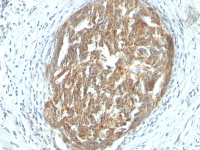 Formalin-fixed, paraffin-embedded human Ovarian Carcinoma stained with VEGF Monoclonal Antibody (SPM225).