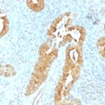 Formalin-fixed, paraffin-embedded human Colon stained with Villin Monoclonal Antibody (VIL1/1325).