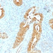 Formalin-fixed, paraffin-embedded human Colon stained with Villin Monoclonal Antibody (VIL1/1325).