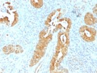 Formalin-fixed, paraffin-embedded human Colon stained with Villin Monoclonal Antibody (VIL1/1325).