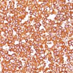 Formalin-fixed, paraffin-embedded human Melanoma stained with Vimentin Monoclonal Antibody (SPM576).