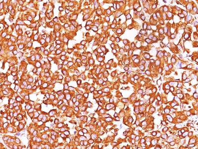 Formalin-fixed, paraffin-embedded human Melanoma stained with Vimentin Monoclonal Antibody (SPM576).