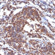 Formalin-fixed, paraffin-embedded human Melanoma stained with Vimentin Monoclonal Antibody (LN-6).