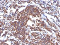 Formalin-fixed, paraffin-embedded human Melanoma stained with Vimentin Monoclonal Antibody (LN-6).