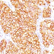 Formalin-fixed, paraffin-embedded human Renal Cell Carcinoma stained with RCC Monoclonal Antibody (66.4.C2).