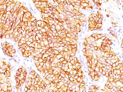 Formalin-fixed, paraffin-embedded human Renal Cell Carcinoma stained with RCC Monoclonal Antibody (66.4.C2).
