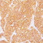 Formalin-fixed, paraffin-embedded human Renal Cell Carcinoma stained with RCC Monoclonal Antibody (SPM314).