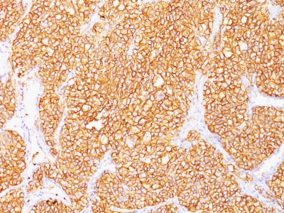 Formalin-fixed, paraffin-embedded human Renal Cell Carcinoma stained with RCC Monoclonal Antibody (SPM314).