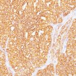 Formalin-fixed, paraffin-embedded human Renal Cell Carcinoma stained with RCC Monoclonal Antibody (SPM487).