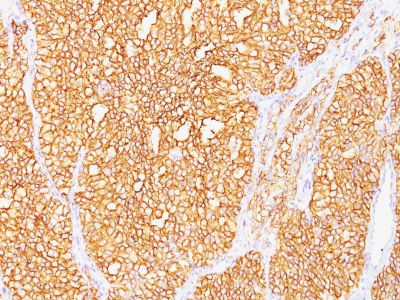 Formalin-fixed, paraffin-embedded human Renal Cell Carcinoma stained with RCC Monoclonal Antibody (SPM487).