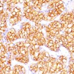 Formalin-fixed, paraffin-embedded human Renal Cell Carcinoma stained with PNA Monoclonal Antibody (PN-15).