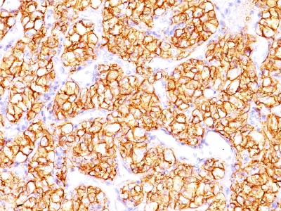 Formalin-fixed, paraffin-embedded human Renal Cell Carcinoma stained with PNA Monoclonal Antibody (PN-15).