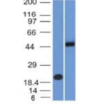 Formalin-fixed, paraffin-embedded human Renal Cell Carcinoma stained with PAX8 Monoclonal Antibody (PAX8/1492).