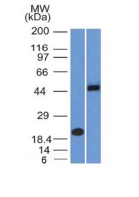 Formalin-fixed, paraffin-embedded human Renal Cell Carcinoma stained with PAX8 Monoclonal Antibody (PAX8/1492).