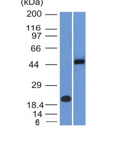 Formalin-fixed, paraffin-embedded human Renal Cell Carcinoma stained with PAX8 Monoclonal Antibody (PAX8/1492).