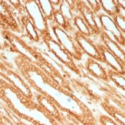 Formalin-fixed, paraffin-embedded human Renal Cell Carcinoma stained with Calnexin Monoclonal Antibody (CANX/1541).