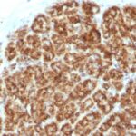 Formalin-fixed, paraffin-embedded Human Colon Carcinoma stained with MAML2 Monoclonal Antibody (MAML2/132).