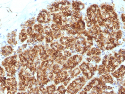 Formalin-fixed, paraffin-embedded Human Colon Carcinoma stained with MAML2 Monoclonal Antibody (MAML2/132).