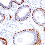 Formalin-fixed, paraffin-embedded Prostate Carcinoma stained with p4 Rabbit Polyclonal Antibody.