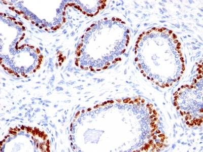Formalin-fixed, paraffin-embedded Prostate Carcinoma stained with p4 Rabbit Polyclonal Antibody.