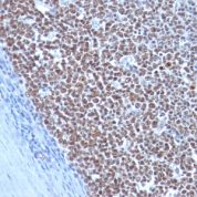Formalin-fixed, paraffin-embedded human Testicular Carcinoma stained with Cyclin B1 Monoclonal Antibody (CCNB1/198)