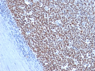 Formalin-fixed, paraffin-embedded human Testicular Carcinoma stained with Cyclin B1 Monoclonal Antibody (CCNB1/198)