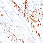 Formalin-fixed, paraffin-embedded human Skin stained with CD1a Monoclonal Antibody (O1+C1A/711).