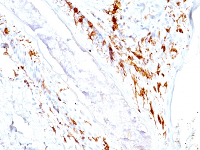 Formalin-fixed, paraffin-embedded human Skin stained with CD1a Monoclonal Antibody (O1+C1A/711).