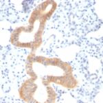 Formalin-fixed, paraffin-embedded human Melanoma stained with CD86 Monoclonal Antibody (SPM6).