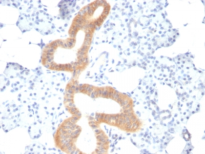 Formalin-fixed, paraffin-embedded human Melanoma stained with CD86 Monoclonal Antibody (SPM6).