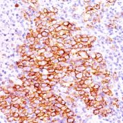 Formalin-fixed, paraffin-embedded human Hodgkin's lymphoma stained with CD3 Ab (CD3/412).