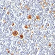 Formalin-fixed, paraffin-embedded human Hodgkin's Lymphoma stained with CD3 Monoclonal Antibody (Ki-1/779).