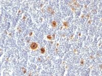 Formalin-fixed, paraffin-embedded human Hodgkin's Lymphoma stained with CD3 Monoclonal Antibody (Ki-1/779).